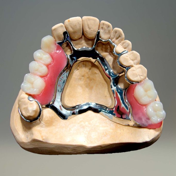 Prothèse adjointe chassis métalique deplante labs