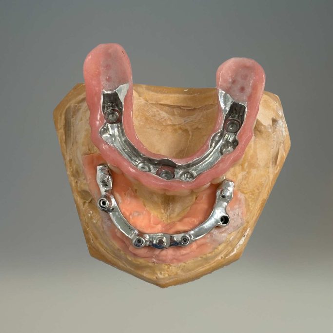 Prothèse adjointe implantaire barre ot equator deplante labs
