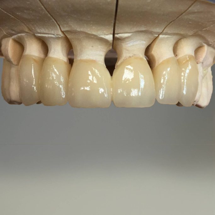La prothèse conjointe zircone maquillée deplante labs
