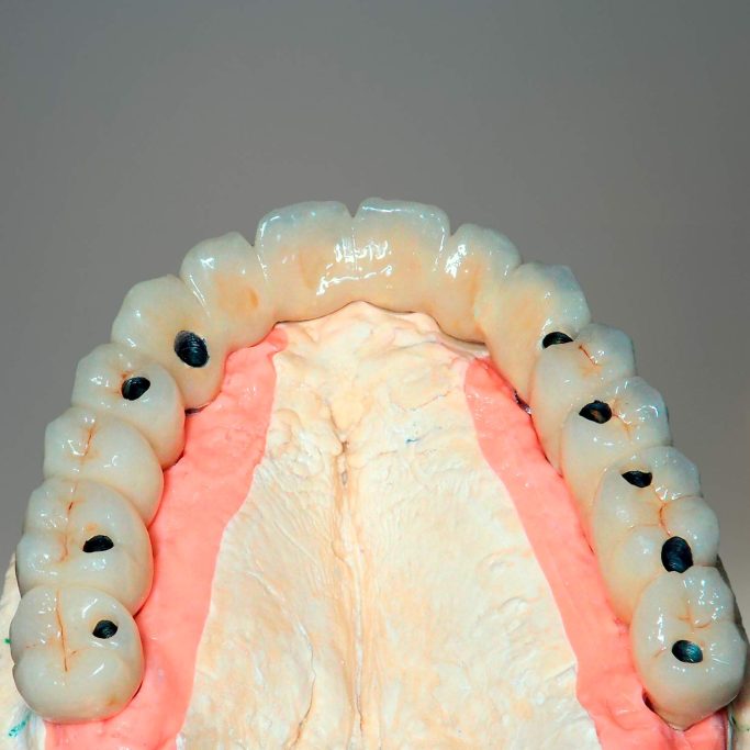 Prothèse conjointe implantaire complet transvisée céramique   deplante labs