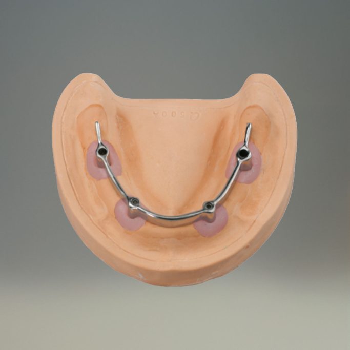 Prothèse adjointe implantaire Barre Ackerman deplante labs