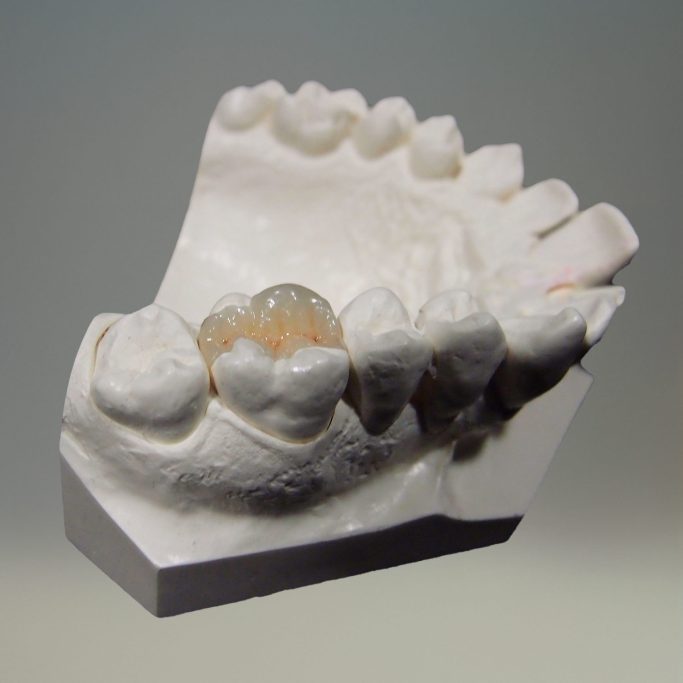 La prothèse conjointe emax onlay deplante labs