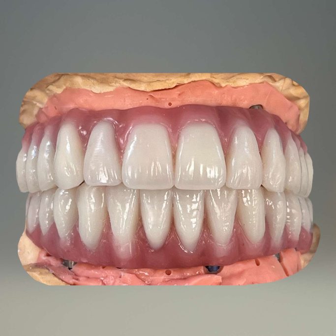Prothèse adjointe implantaire bridge complet transvissé deplante labs