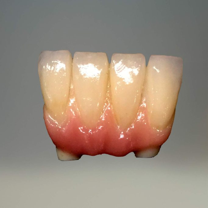 La prothèse conjointe zircone deplante labs