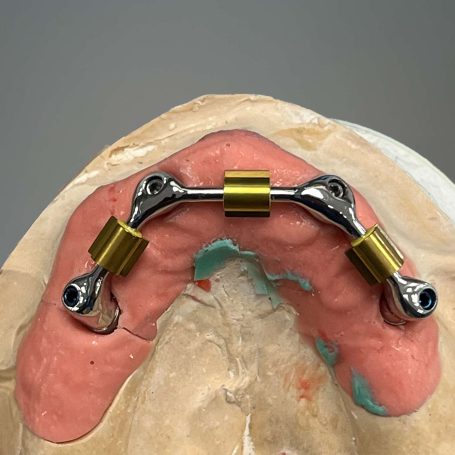 Prothèse adjointe implantaire Prothèse adjointe implantaire