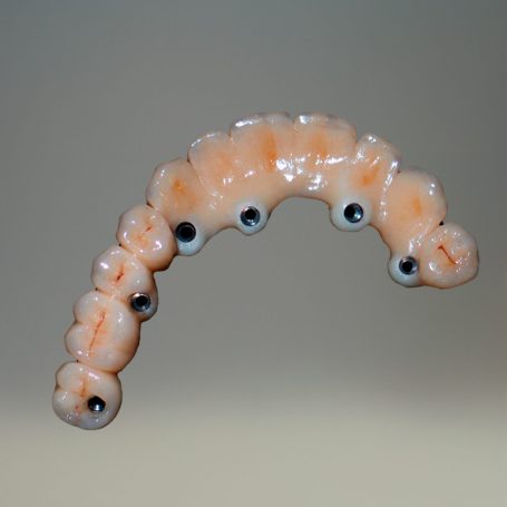 Prothèse conjointe implantaire Prothèse conjointe implantaire