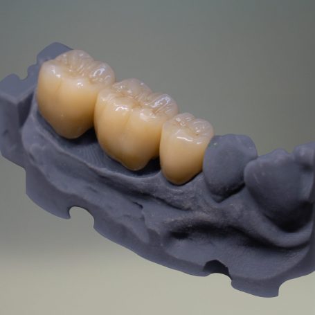 Prothèse conjointe Prothèse conjointe