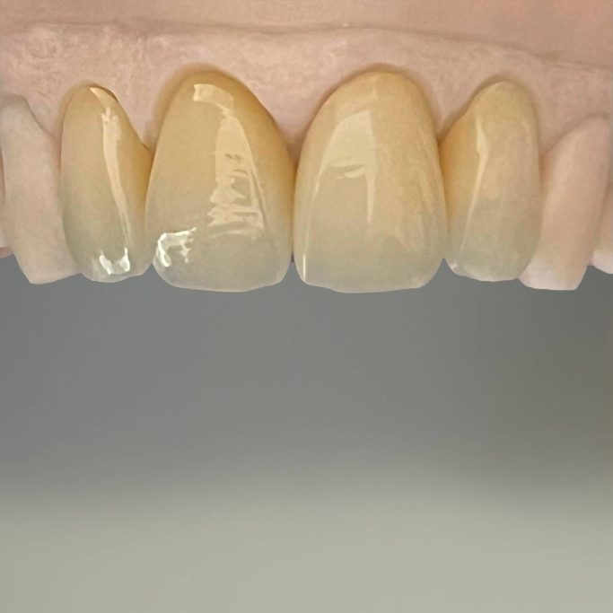 La prothèse conjointe facette Emax deplante labs