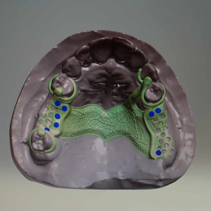 Prothèse adjointe implantaire bridge complet transvissé deplante labs