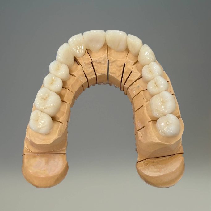 La prothèse conjointe full zircone maquillée deplante labs