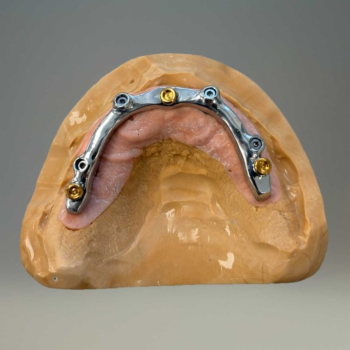 Prothèse adjointe implantaire barre locator deplante labs